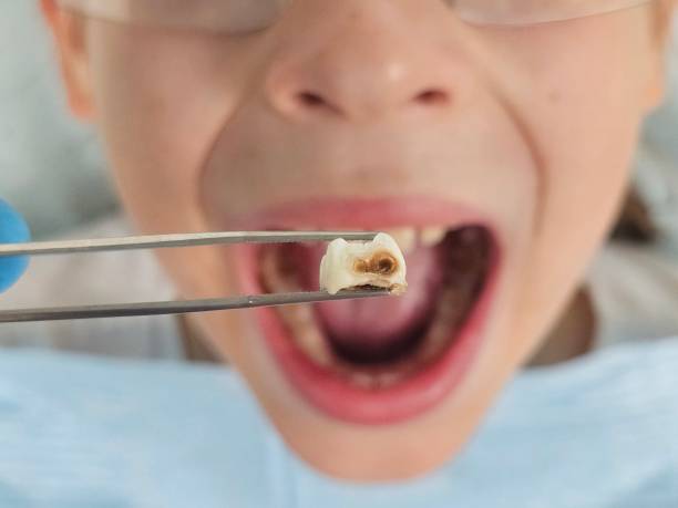 Best Emergency Treatment for Dental Infections or Abscesses in Southwest Sandhill, TX